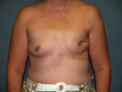 Breast Reconstruction Before & After Patient #2259