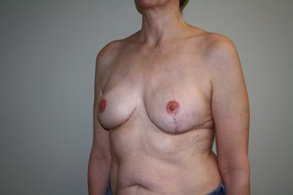 Breast Reconstruction Before & After Patient #1797