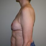 Breast Reconstruction Before & After Patient #1797