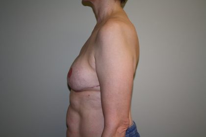 Breast Reconstruction Before & After Patient #1797