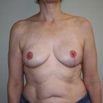 Breast Reconstruction Before & After Patient #1797