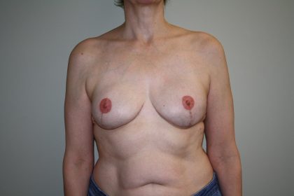 Breast Reconstruction Before & After Patient #1797