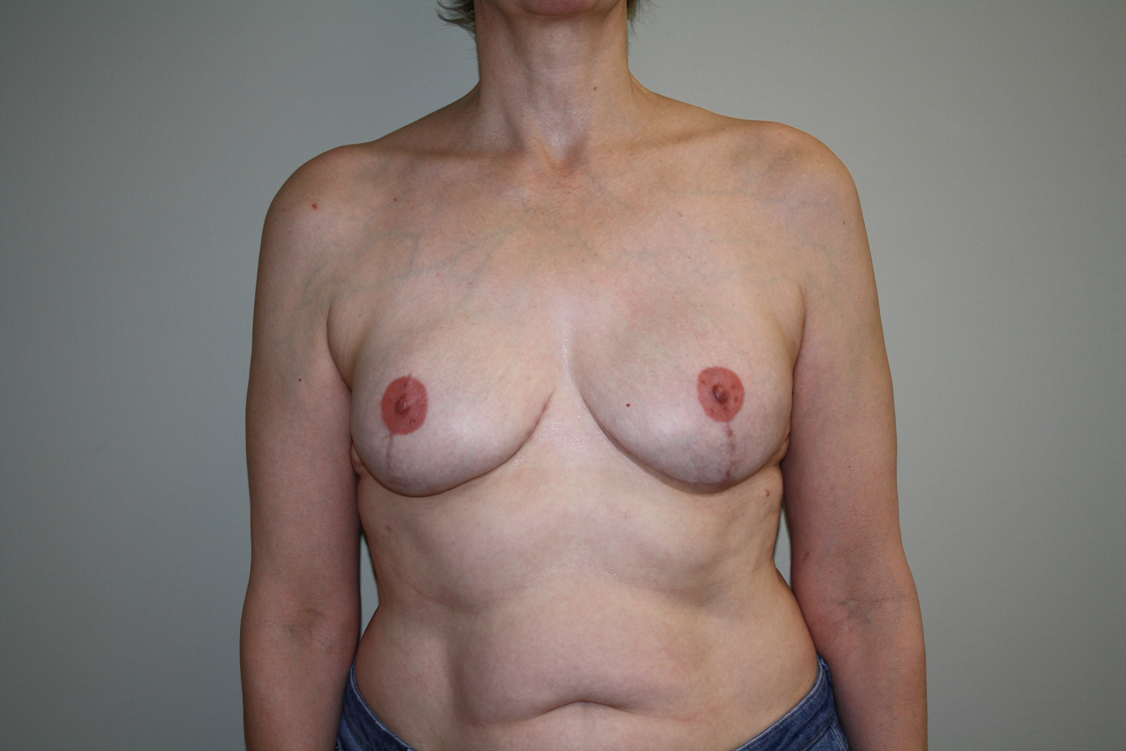 Breast Reconstruction Before & After Patient #1797