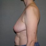 Breast Reconstruction Before & After Patient #1797