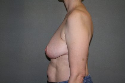 Breast Reconstruction Before & After Patient #1797