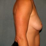 Breast Reconstruction Before & After Patient #2187