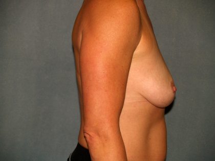 Breast Reconstruction Before & After Patient #2187