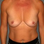 Breast Reconstruction Before & After Patient #2187