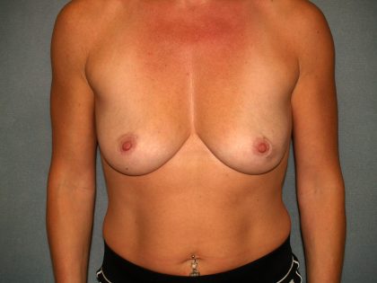 Breast Reconstruction Before & After Patient #2187