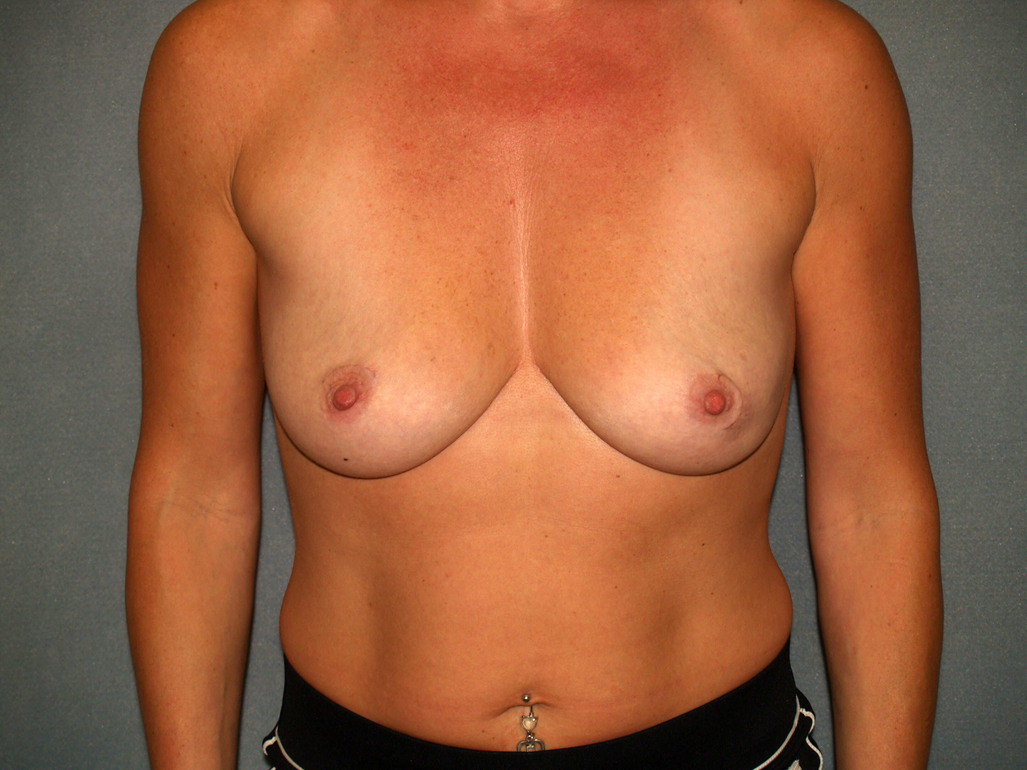 Breast Reconstruction Before & After Patient #2187