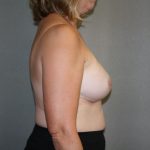 Breast Reconstruction Before & After Patient #1977