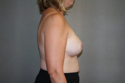 Breast Reconstruction Before & After Patient #1977