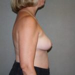 Breast Reconstruction Before & After Patient #1977