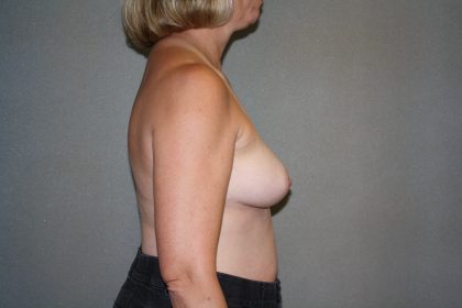 Breast Reconstruction Before & After Patient #1977