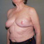 Breast Reconstruction Before & After Patient #2244