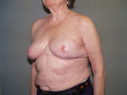 Breast Reconstruction Before & After Patient #2244