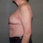 Breast Reconstruction Before & After Patient #2244