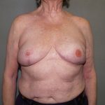 Breast Reconstruction Before & After Patient #2244