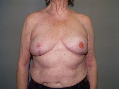 Breast Reconstruction Before & After Patient #2244