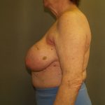 Breast Reconstruction Before & After Patient #2244