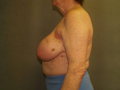 Breast Reconstruction Before & After Patient #2244