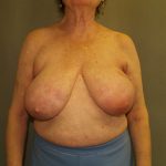 Breast Reconstruction Before & After Patient #2244