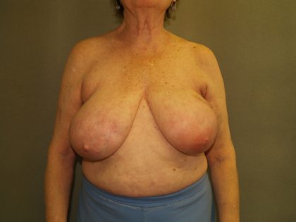 Breast Reconstruction Before & After Patient #2244