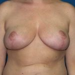 Breast Reduction Before & After Patient #3297