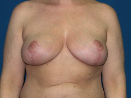 Breast Reduction Before & After Patient #3297