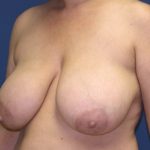 Breast Reduction Before & After Patient #3297