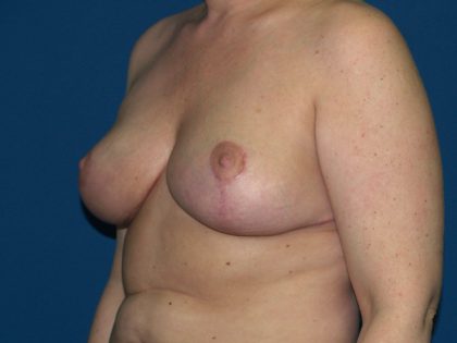 Breast Reduction Before & After Patient #3297