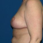 Breast Reduction Before & After Patient #3297