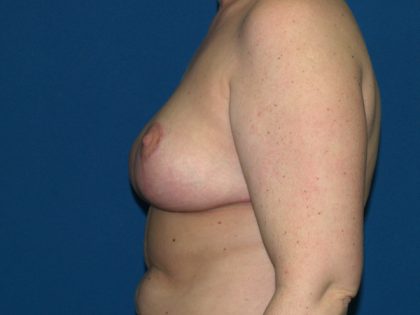 Breast Reduction Before & After Patient #3297