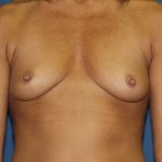 Breast Augmentation Before & After Patient #2892