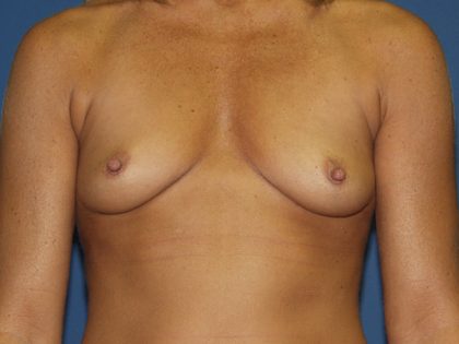 Breast Augmentation Before & After Patient #2892