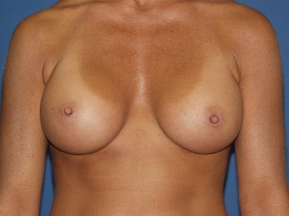 Breast Augmentation Before & After Patient #2892