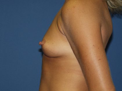 Breast Augmentation Before & After Patient #2892