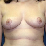 Breast Reduction Before & After Patient #3426