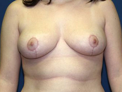 Breast Reduction Before & After Patient #3426