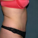 Tummy Tuck Before & After Patient #2005