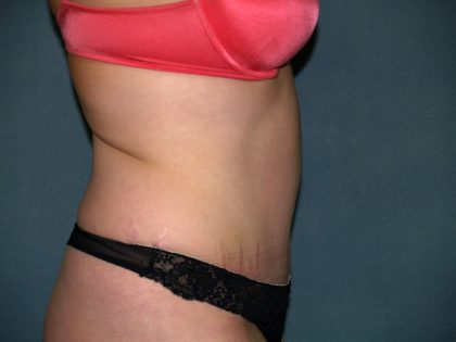 Tummy Tuck Before & After Patient #2005