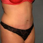 Tummy Tuck Before & After Patient #2005