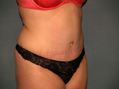 Tummy Tuck Before & After Patient #2005