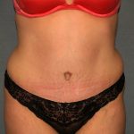 Tummy Tuck Before & After Patient #2005