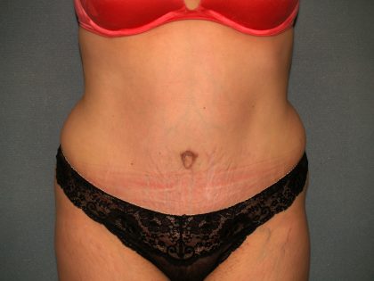 Tummy Tuck Before & After Patient #2005