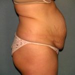 Tummy Tuck Before & After Patient #2005