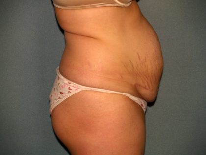 Tummy Tuck Before & After Patient #2005