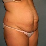 Tummy Tuck Before & After Patient #2005