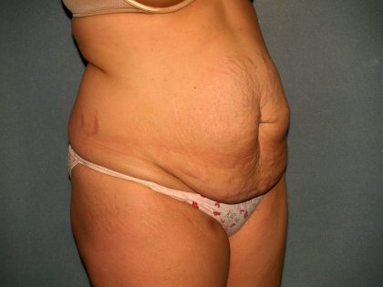 Tummy Tuck Before & After Patient #2005