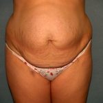 Tummy Tuck Before & After Patient #2005